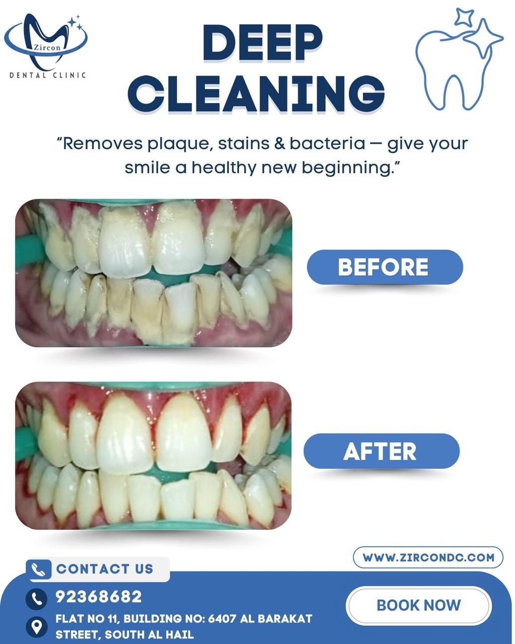 Deep Cleaning before and after