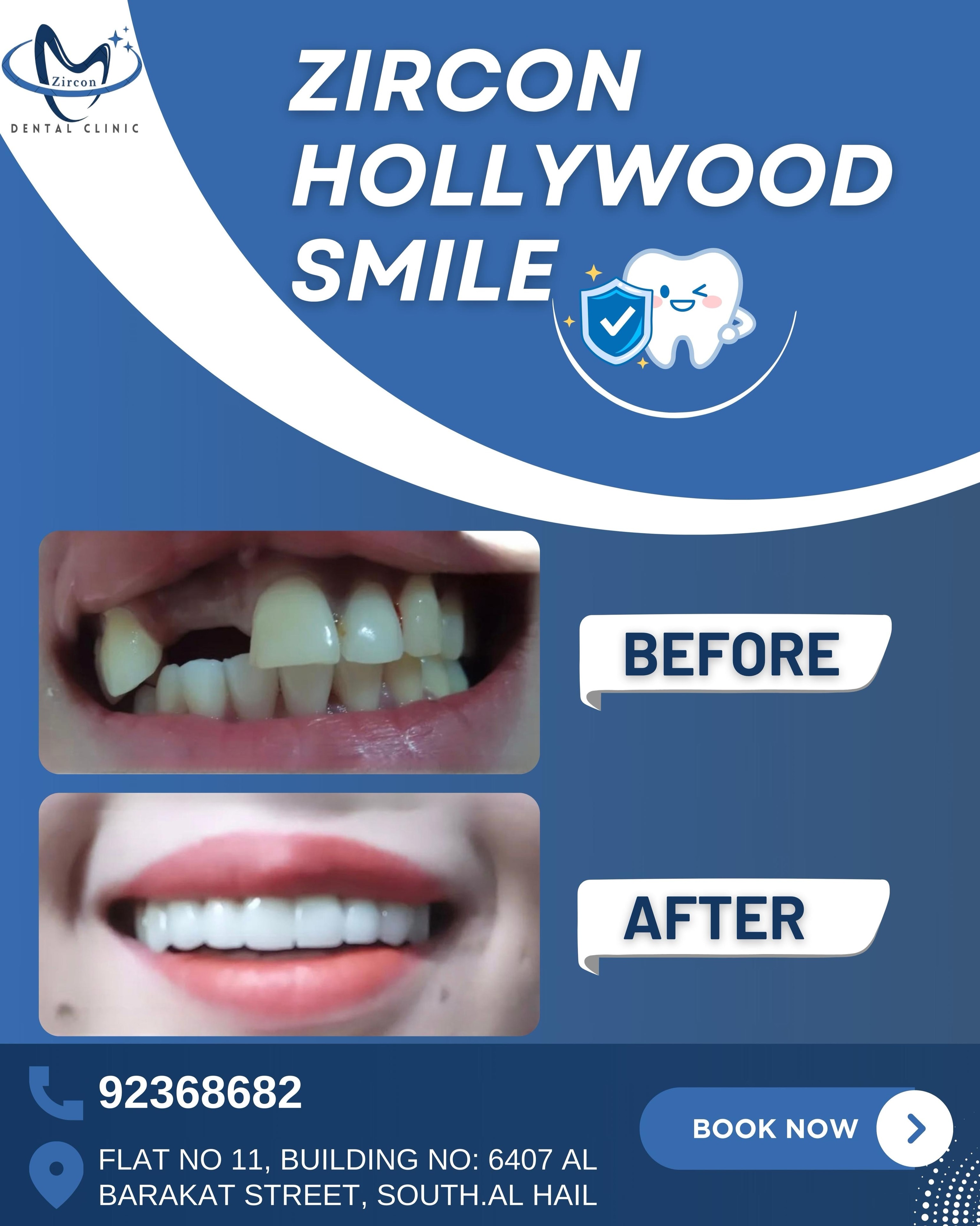 Hollywood Smile before and after