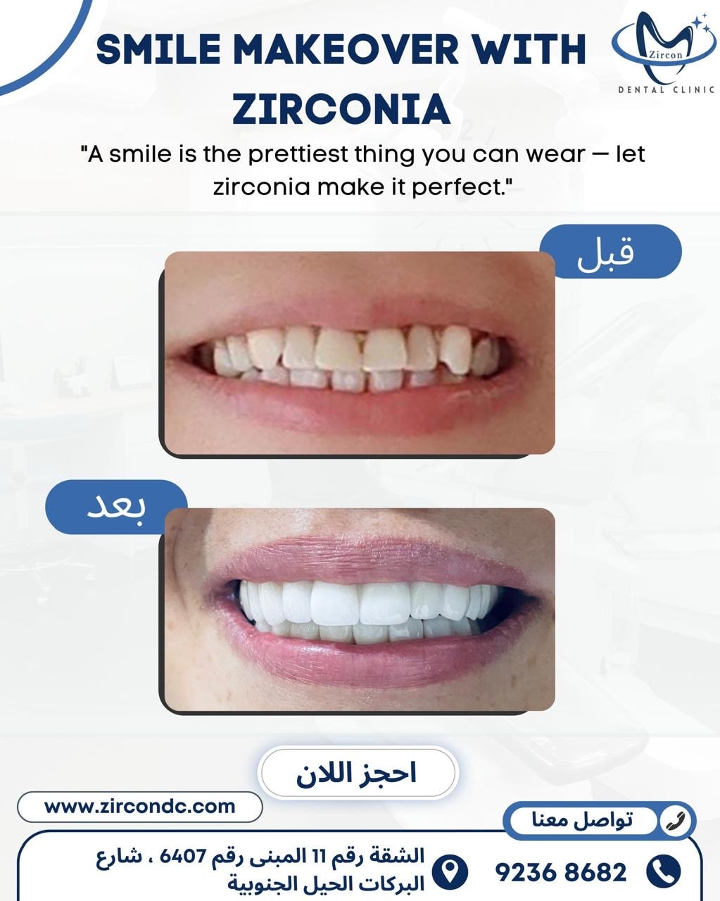 Smile Makeover with Zirconia before and after