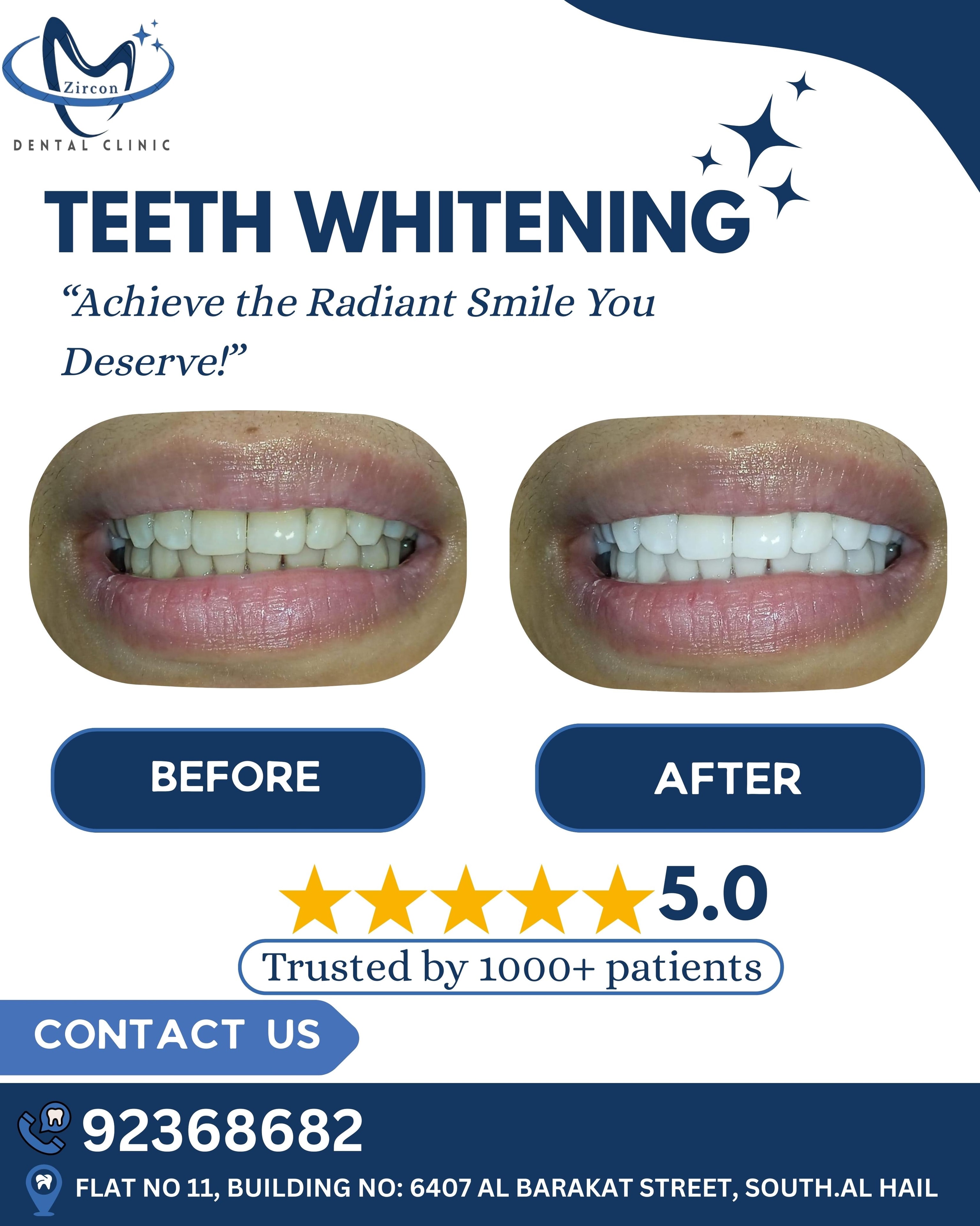 Teeth Whitening before and after