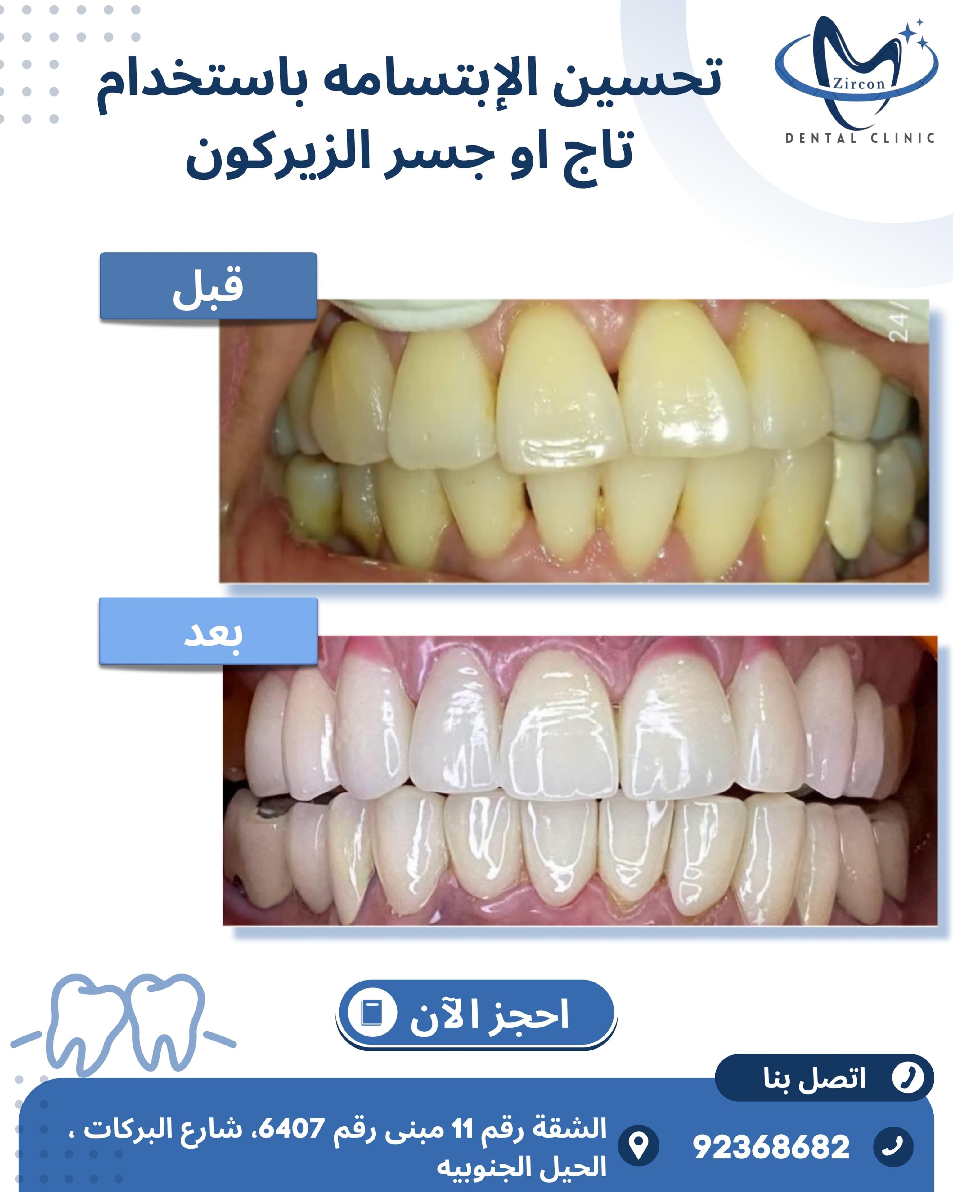 Zirconia Crown & Bridge before and after