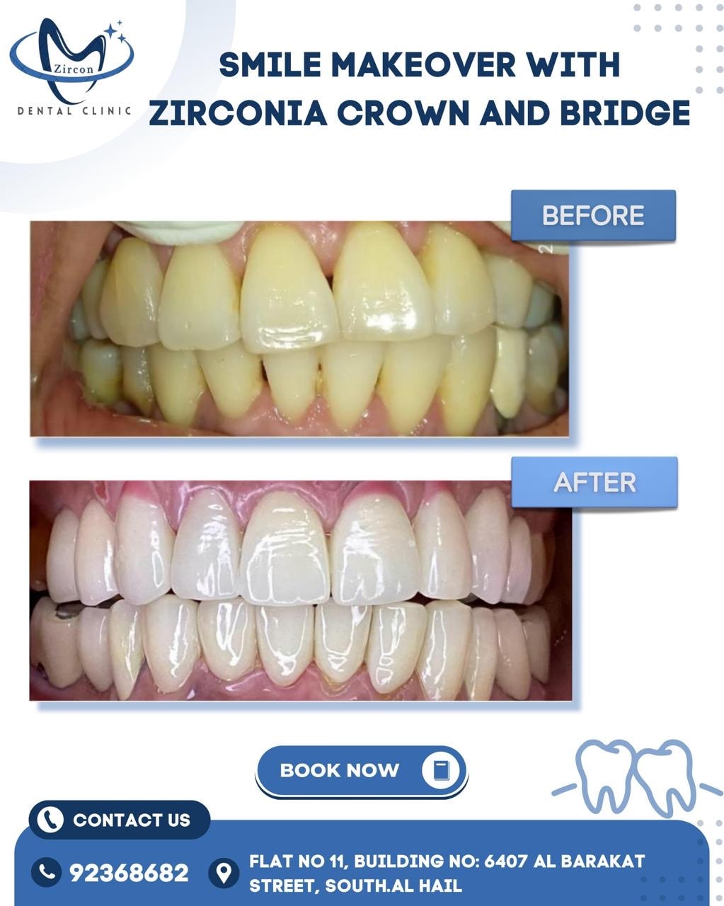 Zirconia Crown & Bridge before and after